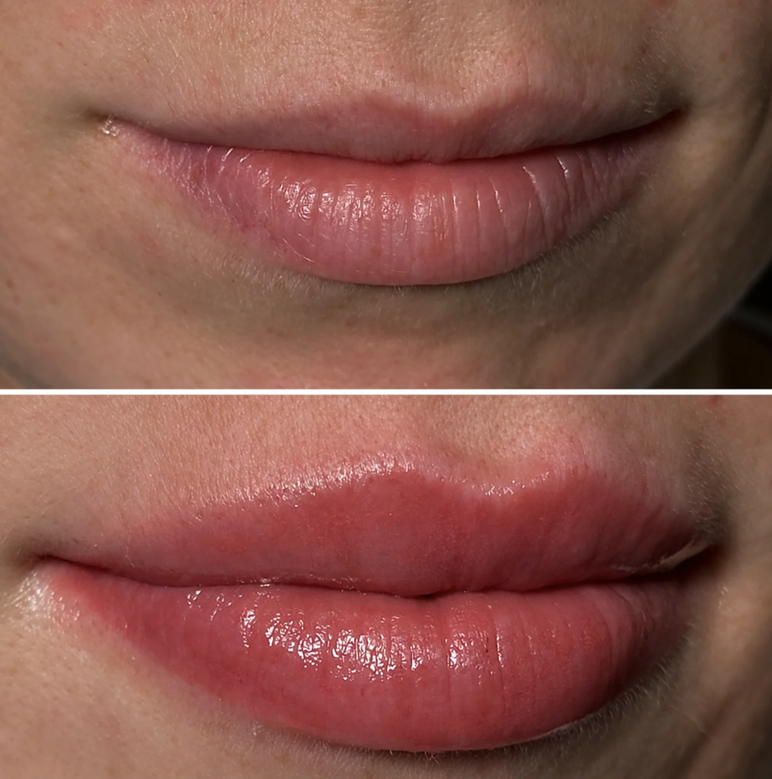 Vorher-Nachher-Ergebnis Lip Blush