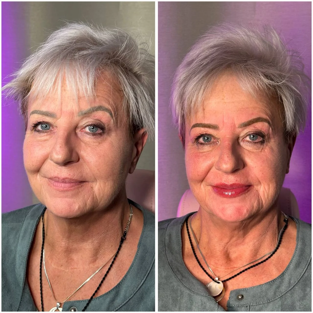 Vorher-Nachher-Ergebnis Lippen & Ausdruck